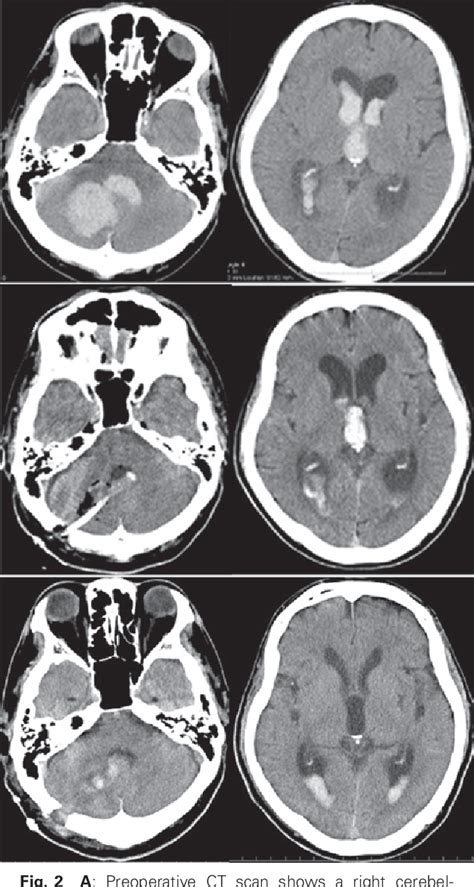 Figure 1 From Endoscopic Hematoma Evacuation For Cerebellar Hemorrhage