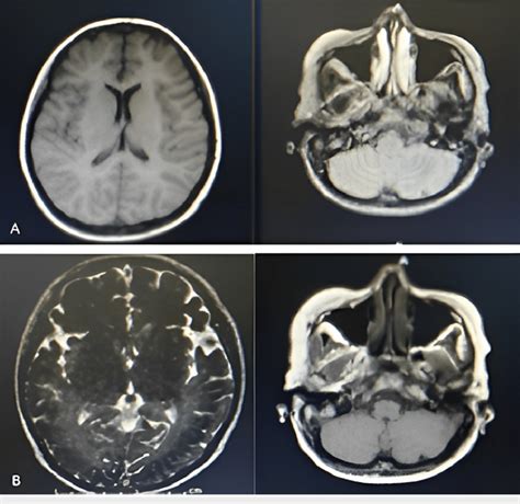 T1 A And T2 Weighted B Cranial Mri On The Axial View Taken During