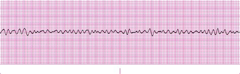 acls rythmn review critical care education
