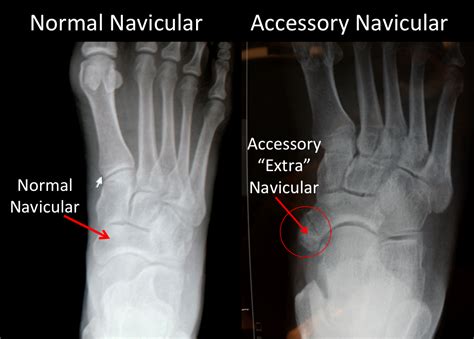 Accessory Navicular Bone - FootEducation