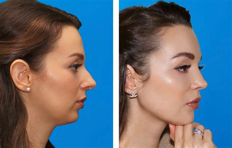 Chin Surgery Genioplasty