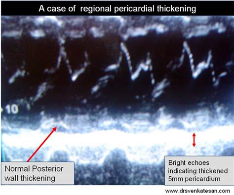 Beware Of Non Infarct Q Waves A Women With An Unusual Pathological Q