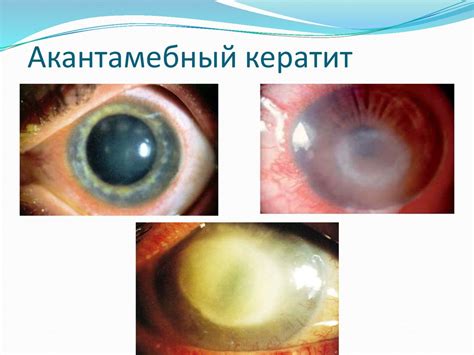 Кератиты. Заболевания роговицы - презентация онлайн