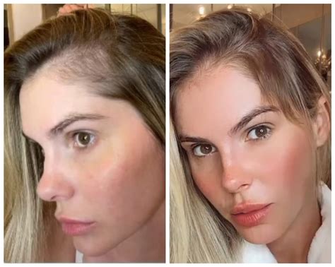 Bárbara Evans relembra queda de cabelo e mostra antes e depois Por