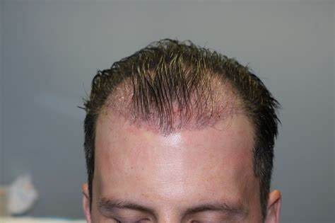 ~2500 Fue Hair Transplant By Dr Panine Chicago Hair Transplant Clinic Hair Transplant