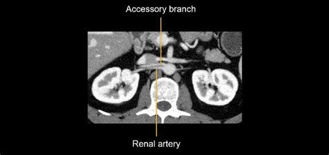 Abdominal Ct Abdominal Arteries • Litfl • Radiology Library