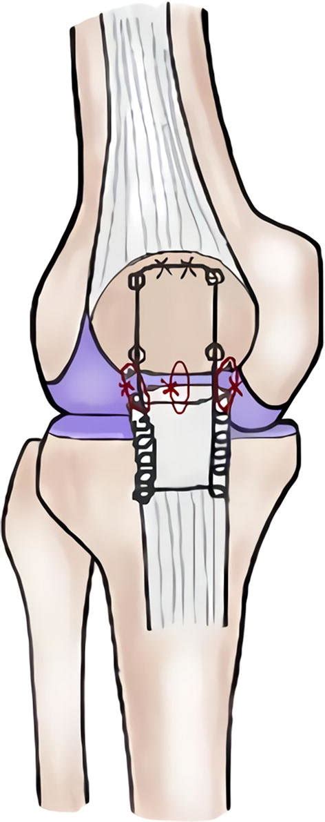 Schematic Drawing Of Patellar Tendon Repair With Krackow Suture Method Download Scientific