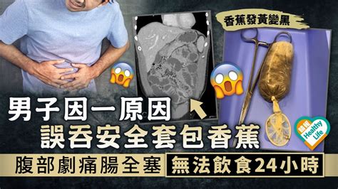 腸道阻塞︳男子因一原因誤吞安全套包香蕉 腹部劇痛腸全塞 無法飲食24小時 晴報 健康 生活健康 D230204