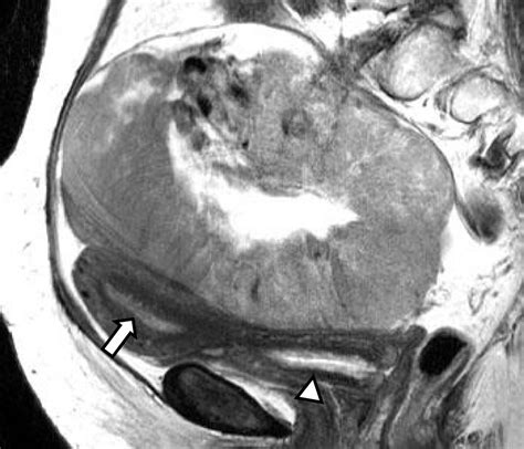 Estrogen Producing Endometrioid Adenocarcinoma Resembling Sex Cord