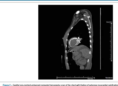 Figure From Extensive Myocardial Calcification In A Heart Transplant