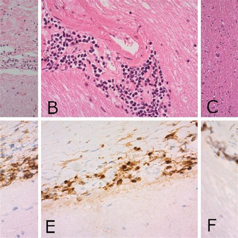 Figure3 Microscopic Pathological Findings In The Brain LPC