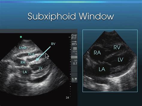 A Positive Fast Exam As Pericardial Effusion Courtesy Of Dr John