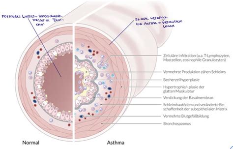 Lunge Erkrankungen Des Bronchialsystems Karteikarten Quizlet