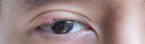 Chalazion définition symptômes diagnostic et traitements