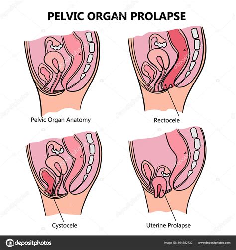 Women Prolapsed Uterus