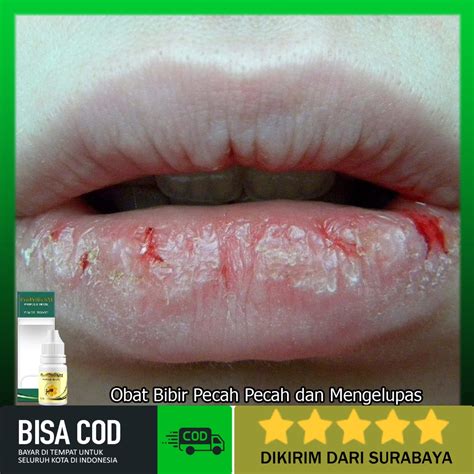 Jual Obat Bibir Pecah Pecah Dan Mengelupas Karena Panas Dalam Bibir