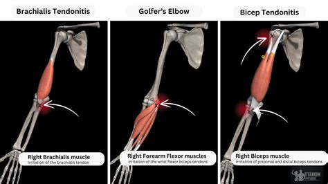 Brachialis Tendonitis Managing Pain At Front Of The Elbow