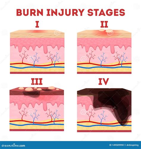 Skin Burn Classification Cartoon Vector | CartoonDealer.com #91276669