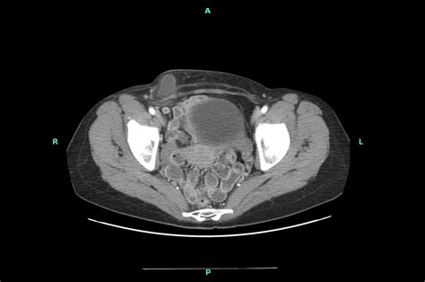 De Garengeot Hernia A Rare Presentation Of A Femoral Hernia