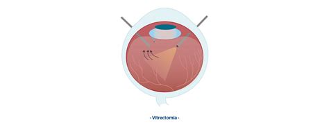 Hemorragia V Trea Qu Es S Ntomas Causas Y Tratamiento Blog De