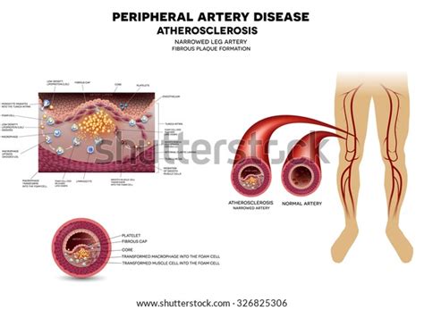 Narrowed Leg Artery By Atherosclerosis Plaque Stock Illustration 326825306