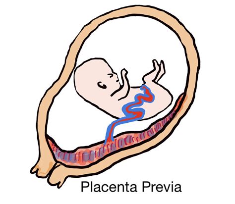 Placenta Anterior Grau Sololearn