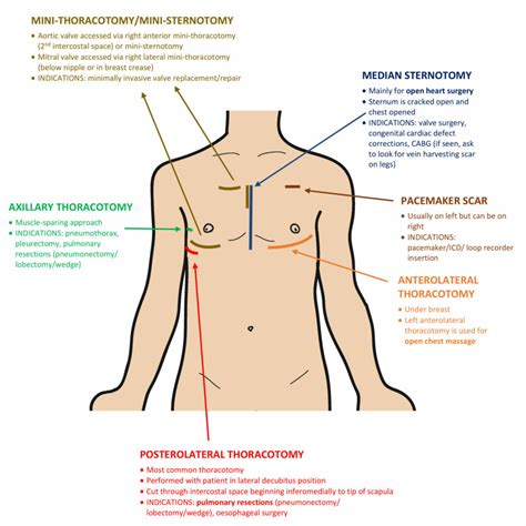 Thoracic Scars Oscestop Osce Learning