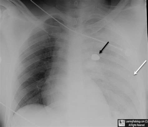 Left Hemothorax X Ray