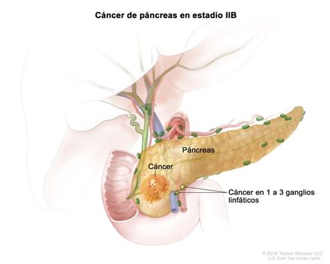 Tratamiento Del C Ncer De P Ncreas Nci