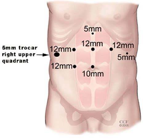 Standard Seven Trocar Placement For Laparoscopic Roux En Y Gastric