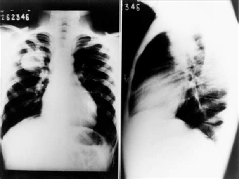 Radiografias Simples Do T Rax Em P A E Perfil Esquerda Massa Em