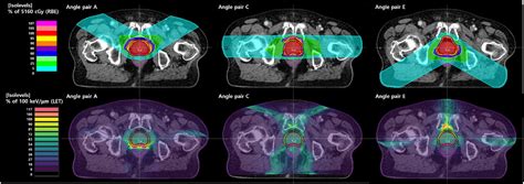 Frontiers Dosimetric Comparison Of Robust Angles In Carbon Ion