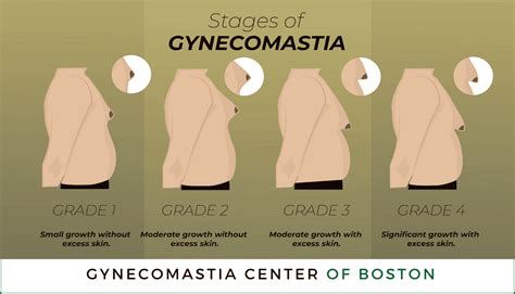 Gynecomastia Grades And Stages Gynecomastia Center Of Boston