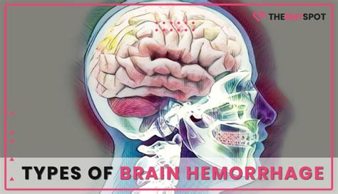 Types Of Brain Hemorrhage Theemtspot