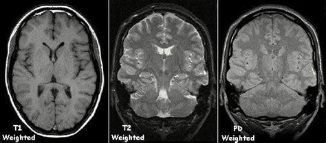 Examples of T1 weighted, T2 weighted and PD weighted MRI images [5 ...