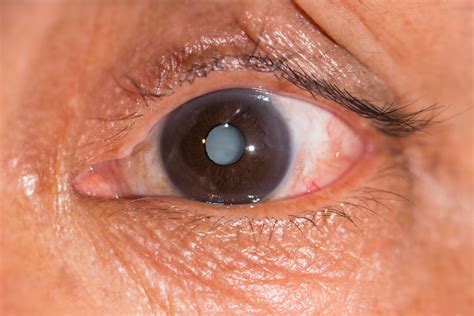 What Is Cataracts In Egypt