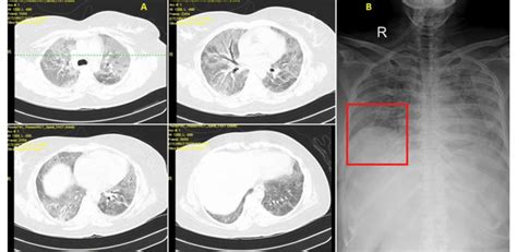 A Multiple Ill Defined Patchy Ground Glass Opacities With Download Scientific Diagram