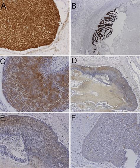 A Immunohistochemistry Of B Catenin Â200 Positively Stained In The Download Scientific