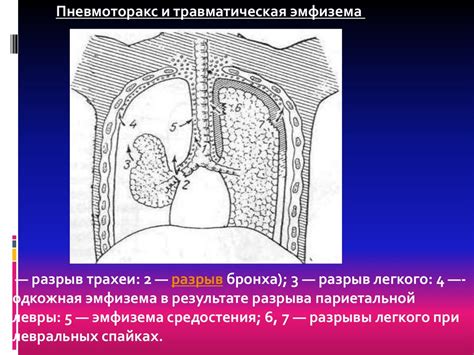 Травмы грудной клетки - презентация онлайн