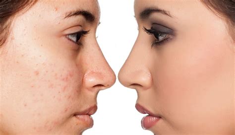 5 Home Remedies To Get Rid Of Stubborn Acne Marks