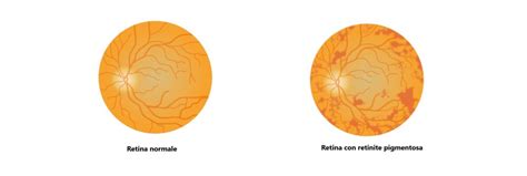 Retinite Pigmentosa Quali Sono I Sintomi Blog Di Clinica Baviera Italia