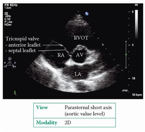 The Right Heart Thoracic Key