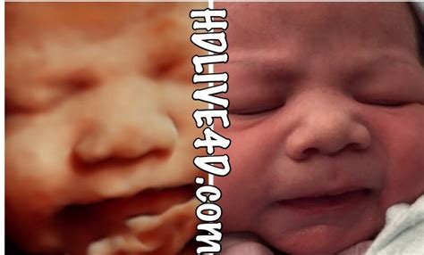 Before After Photo Gallery D Hdlive D D Hd Ultrasound Virginia