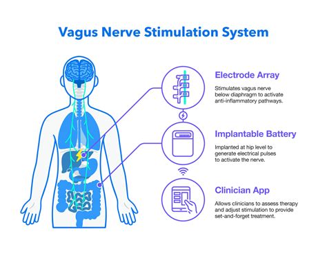 Our Vagus Nerve Stimulation Device Implanted In First Patient With