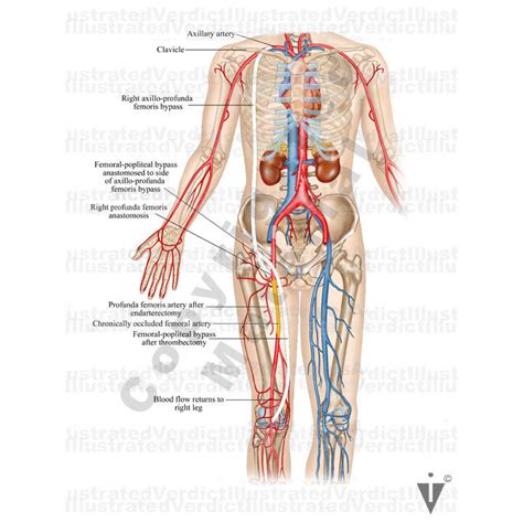 Stock Lower Limb Bypass Of Vasculature Illustrated Verdict