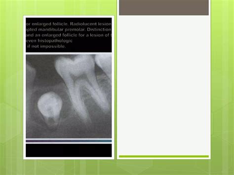 Dentigerous Cyst Ppt