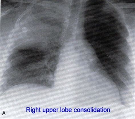 Clinical Pneumonia Flashcards Quizlet