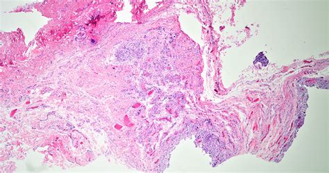 Pathology Outlines Dermoid Cyst