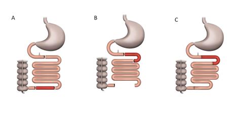 Illustrative Scheme Of Section And Anastomosis Areas In The