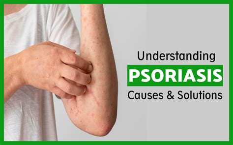 Understanding Psoriasis Causes And Solutions